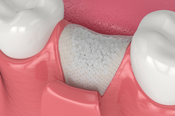 What You Should Know About Bone Grafting