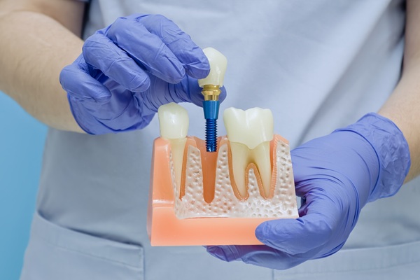 Consult An Implant Specialist To Enhance Your Smile
