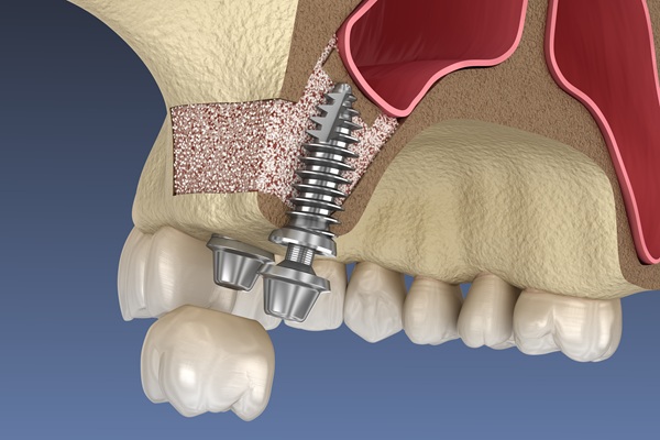 Sinus Lift Procedure And Dental Implants