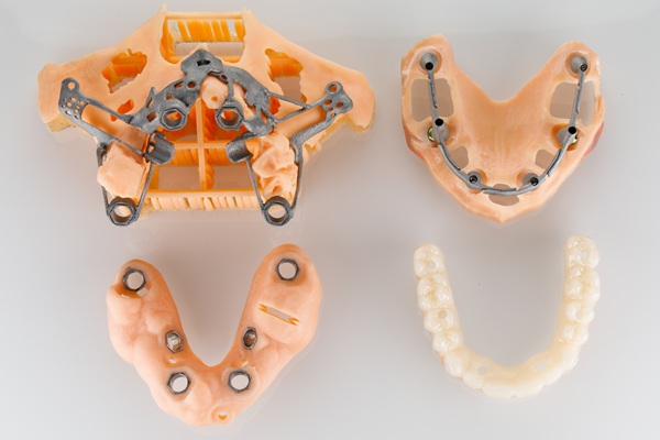 Zygomatic Implants: A Solution For Patients With Severe Bone Loss